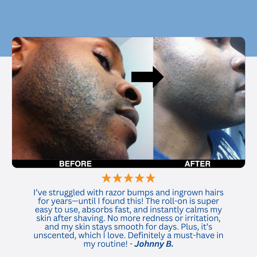 Aeris Ingrown Hair Solution!